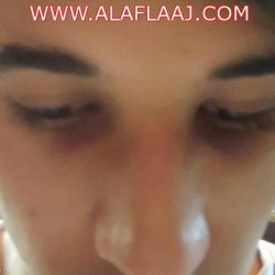 ثلاث حالات اشتباه كورونا بمستشفى الأفلاج العام بينهم طفل