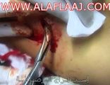 إستخراج رصاصة من قدم عشريني أصيب فيها بإطلاق النار من مسدس