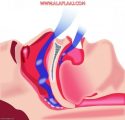 متلازمة نقص التهوية المرتبط بالسمنة