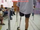 التأهيل يبداء في استقبال طلبات تركيب الأطراف الصناعية وهذه الشروط